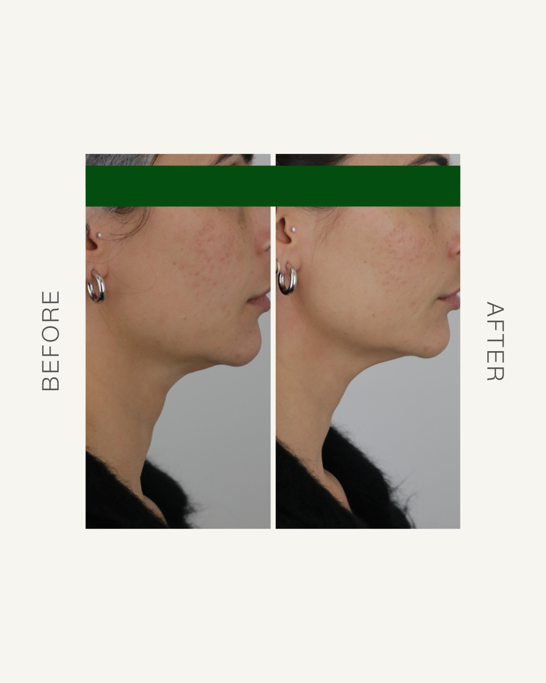 PROFILE PERFECT: THE BUZZ AROUND JAWLINE CONTOURING