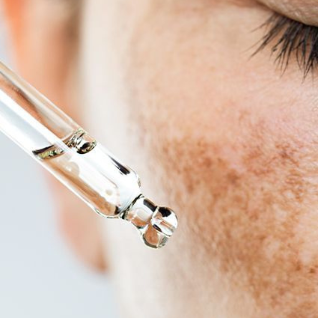 4 Things Your Skin Therapist Wants You to Know About Melasma