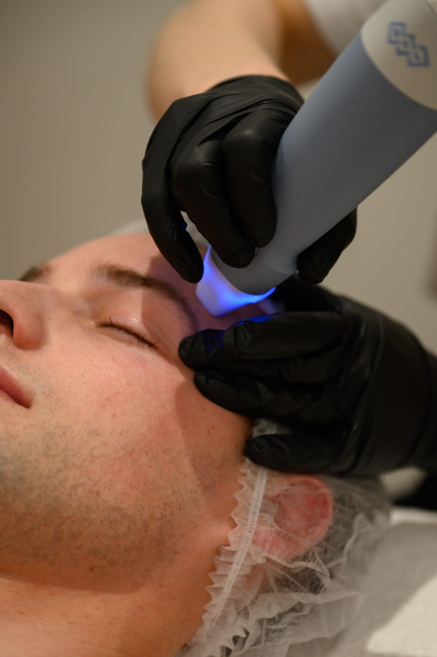 Exion RF Needling
