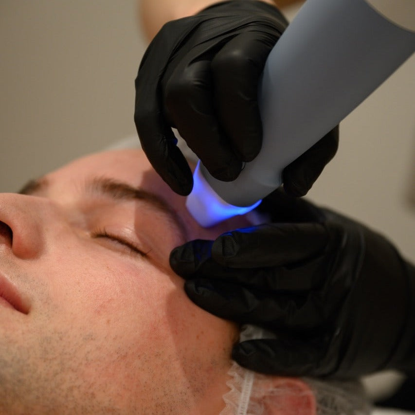 Exion RF Needling