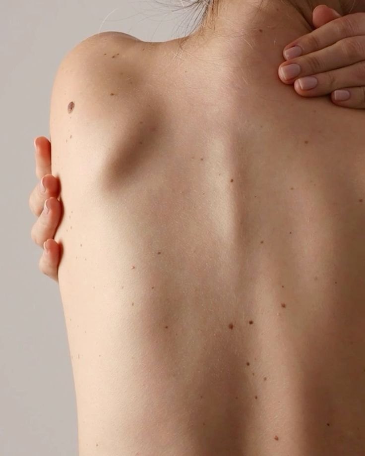 Skin Lesion Removal
